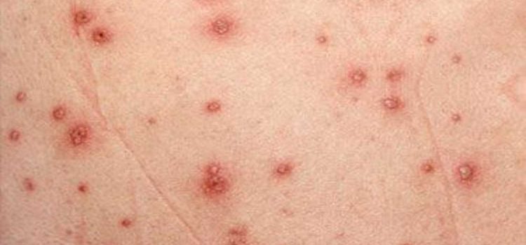 انواع سرطان پوست انواع سرطان پوست