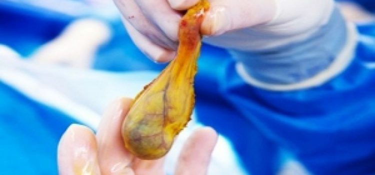 نکاتی برای آنان که با عمل جراحی کیسه صفرا را در آوردهاند جراحی کیسه صفرا